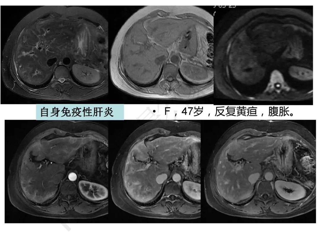 【PPT】纤维组织在肝脏炎性病变MR诊断中的价值