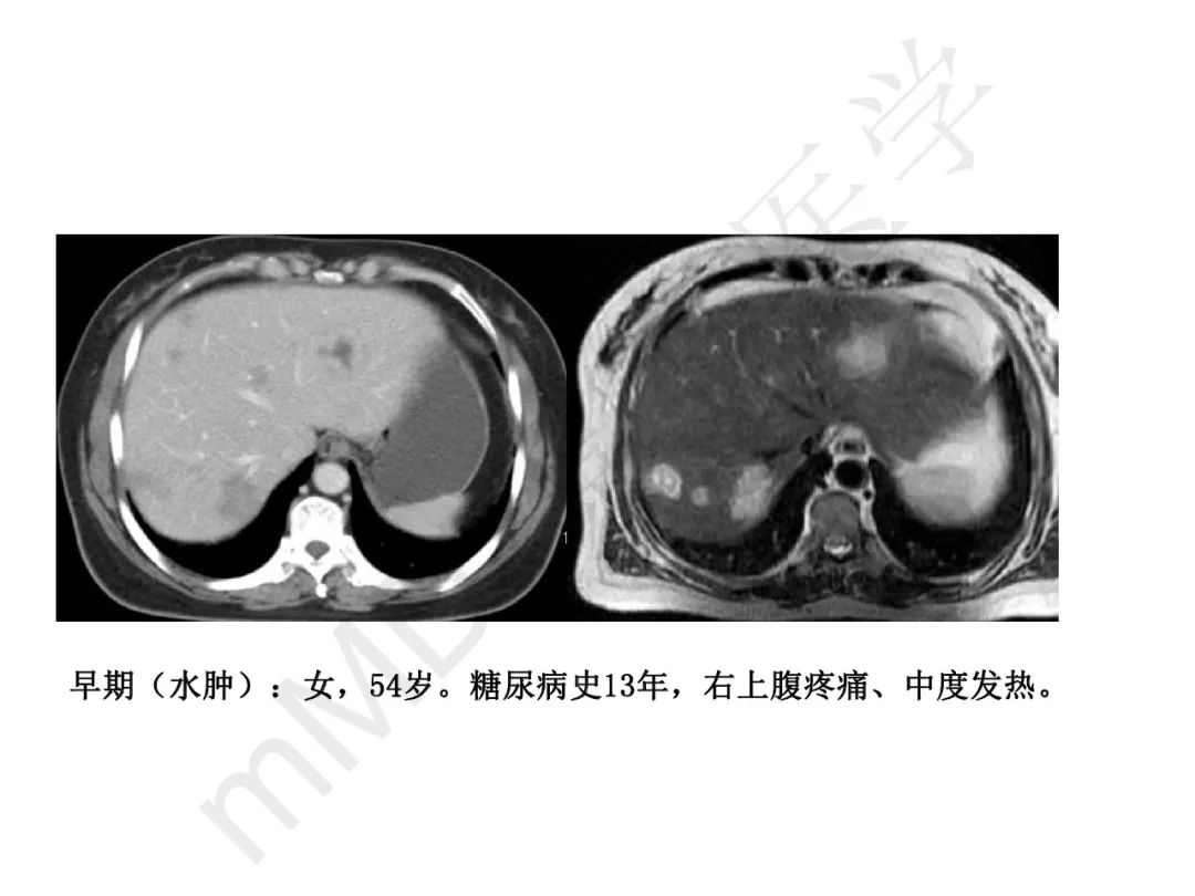 【PPT】纤维组织在肝脏炎性病变MR诊断中的价值