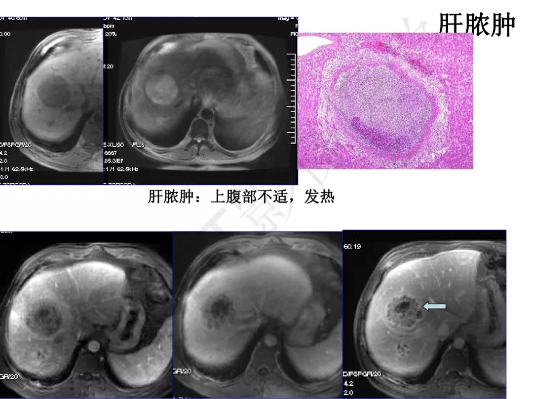 【PPT】纤维组织在肝脏炎性病变MR诊断中的价值