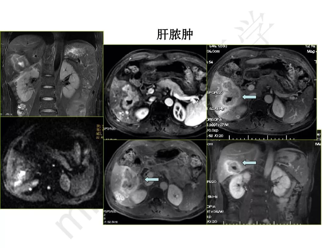 【PPT】纤维组织在肝脏炎性病变MR诊断中的价值