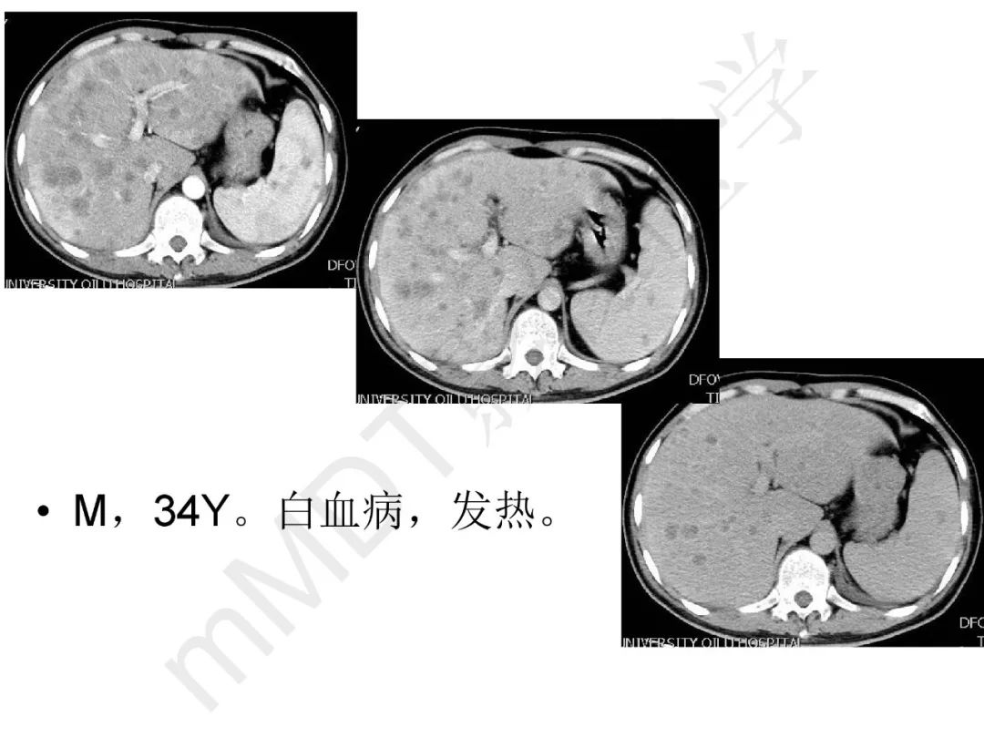 【PPT】纤维组织在肝脏炎性病变MR诊断中的价值