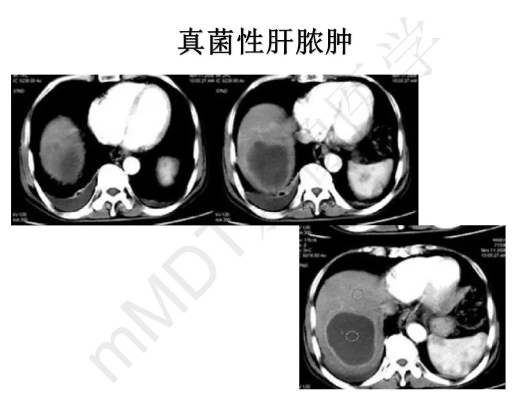 【PPT】纤维组织在肝脏炎性病变MR诊断中的价值