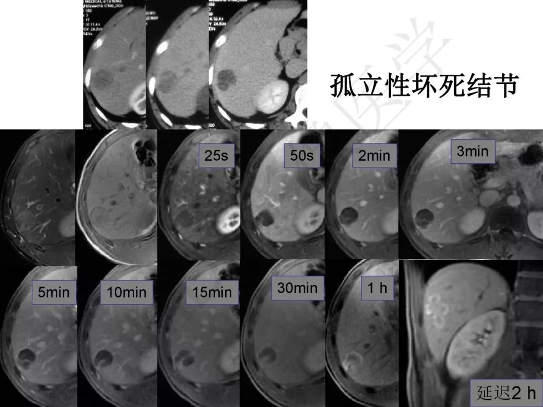 【PPT】纤维组织在肝脏炎性病变MR诊断中的价值