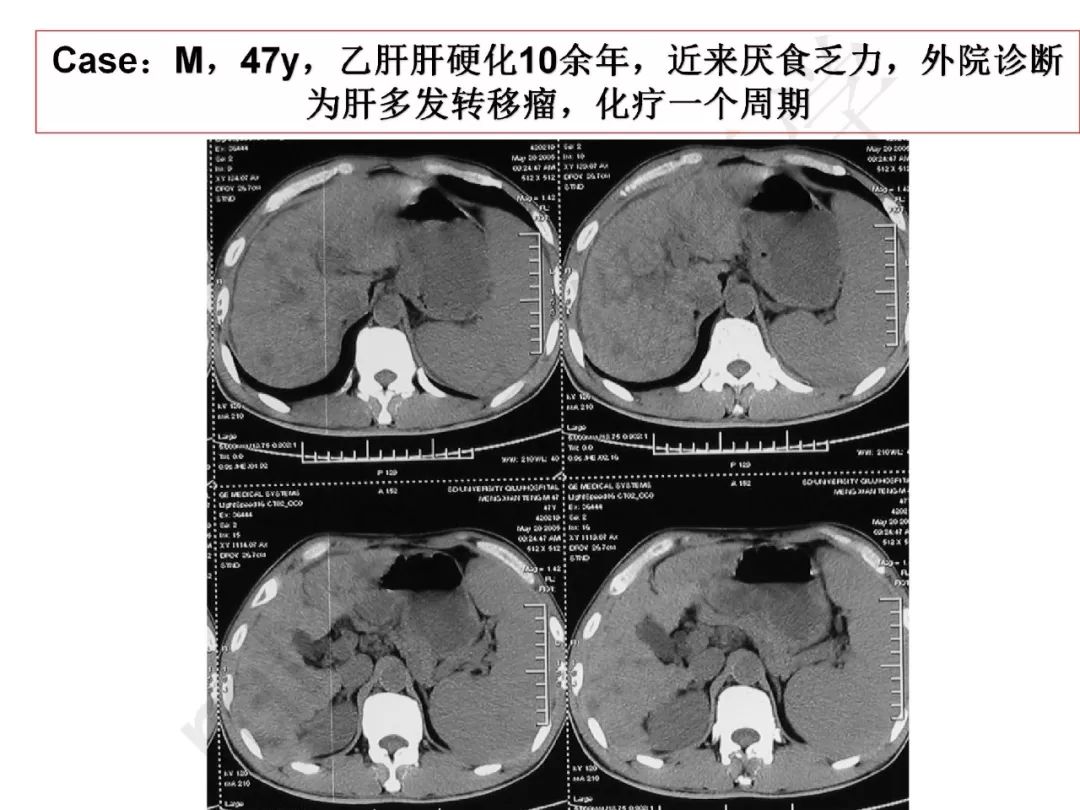 【PPT】纤维组织在肝脏炎性病变MR诊断中的价值
