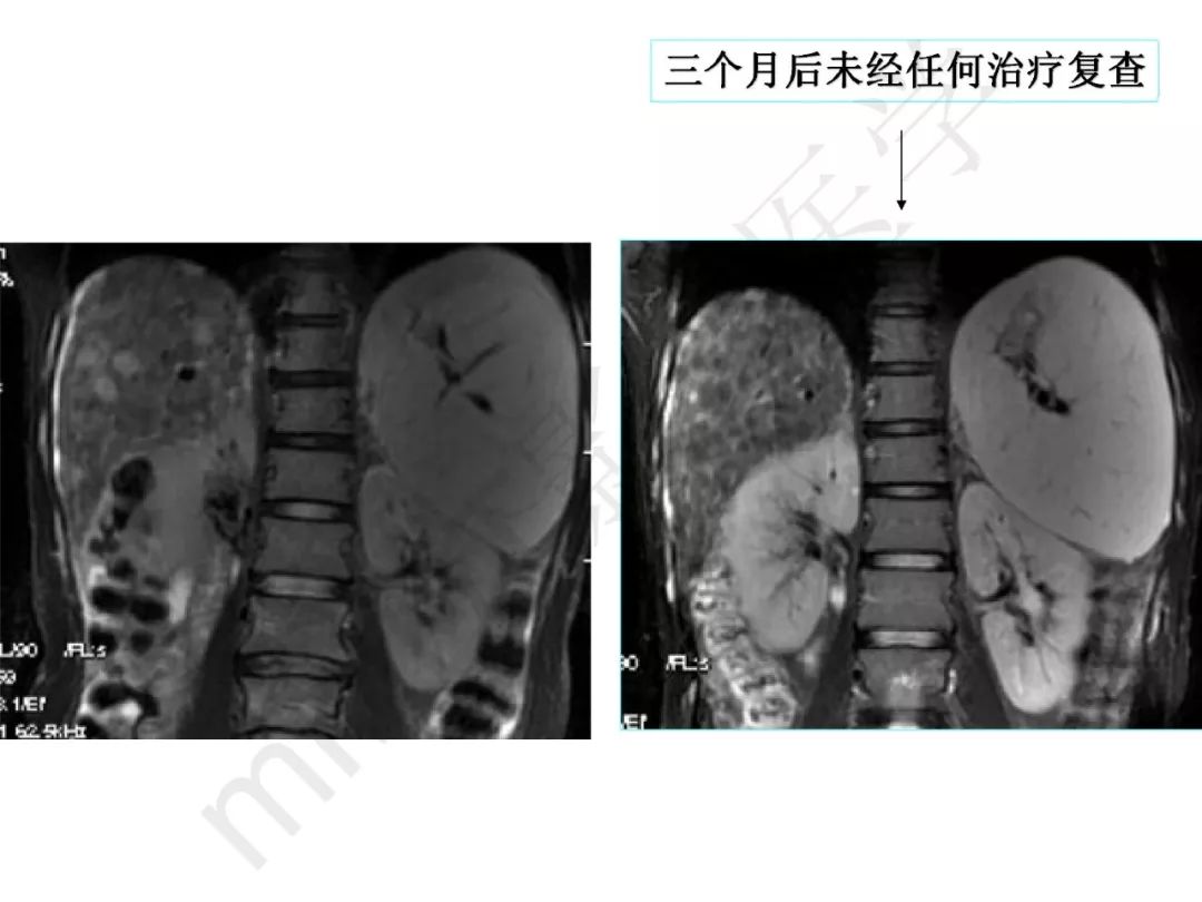 【PPT】纤维组织在肝脏炎性病变MR诊断中的价值