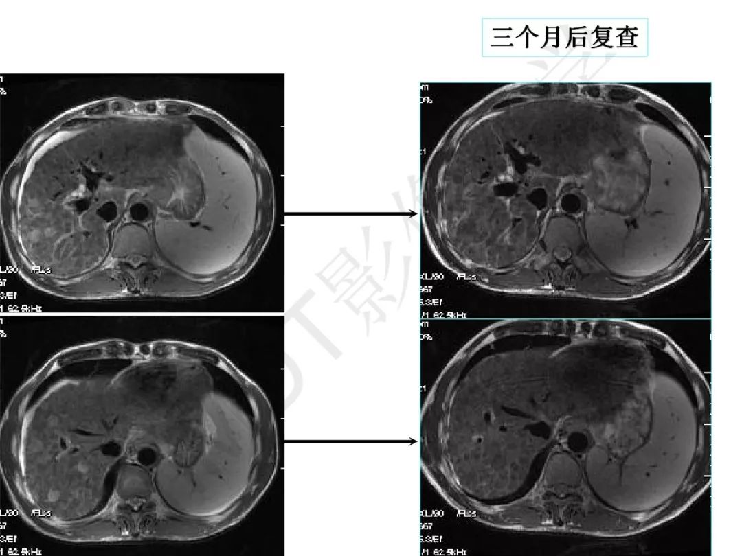 【PPT】纤维组织在肝脏炎性病变MR诊断中的价值