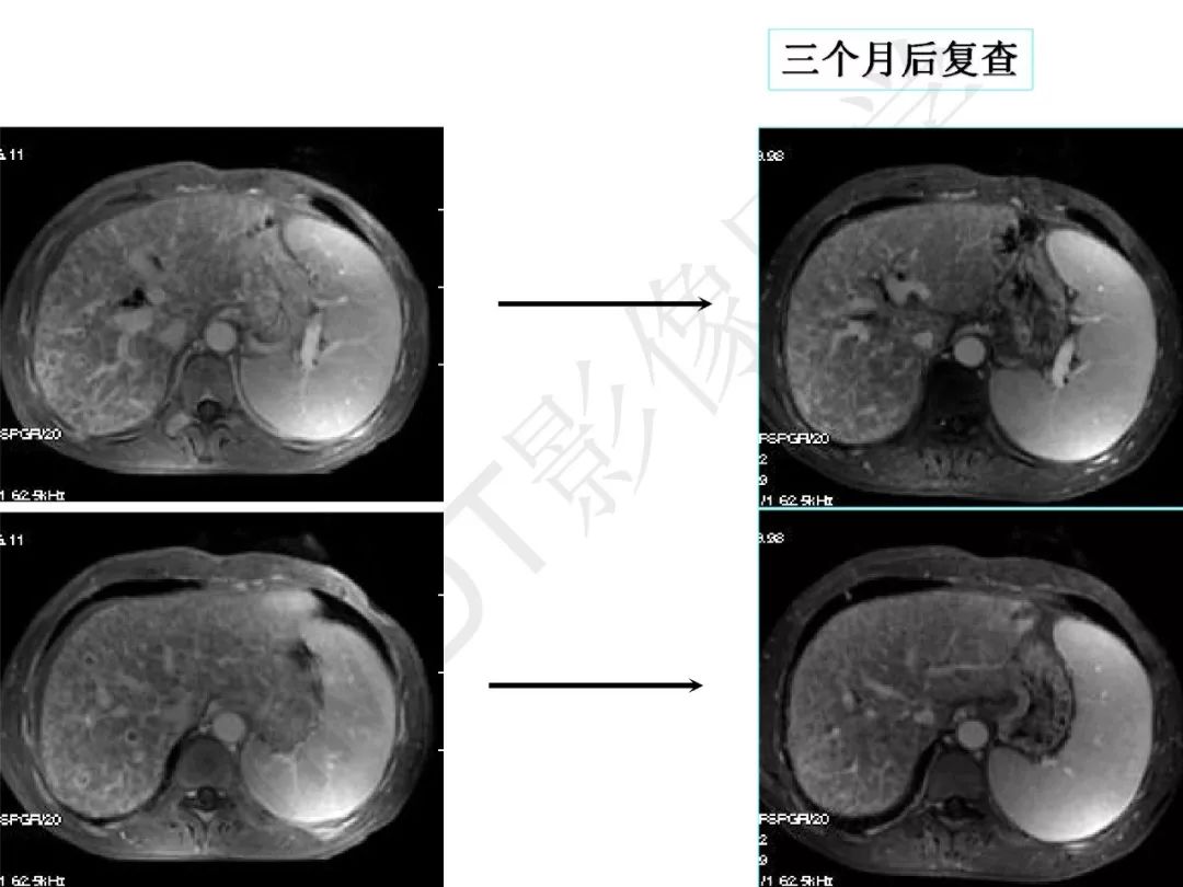 【PPT】纤维组织在肝脏炎性病变MR诊断中的价值