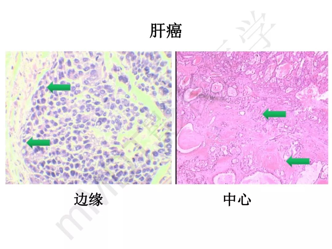 【PPT】纤维组织在肝脏炎性病变MR诊断中的价值