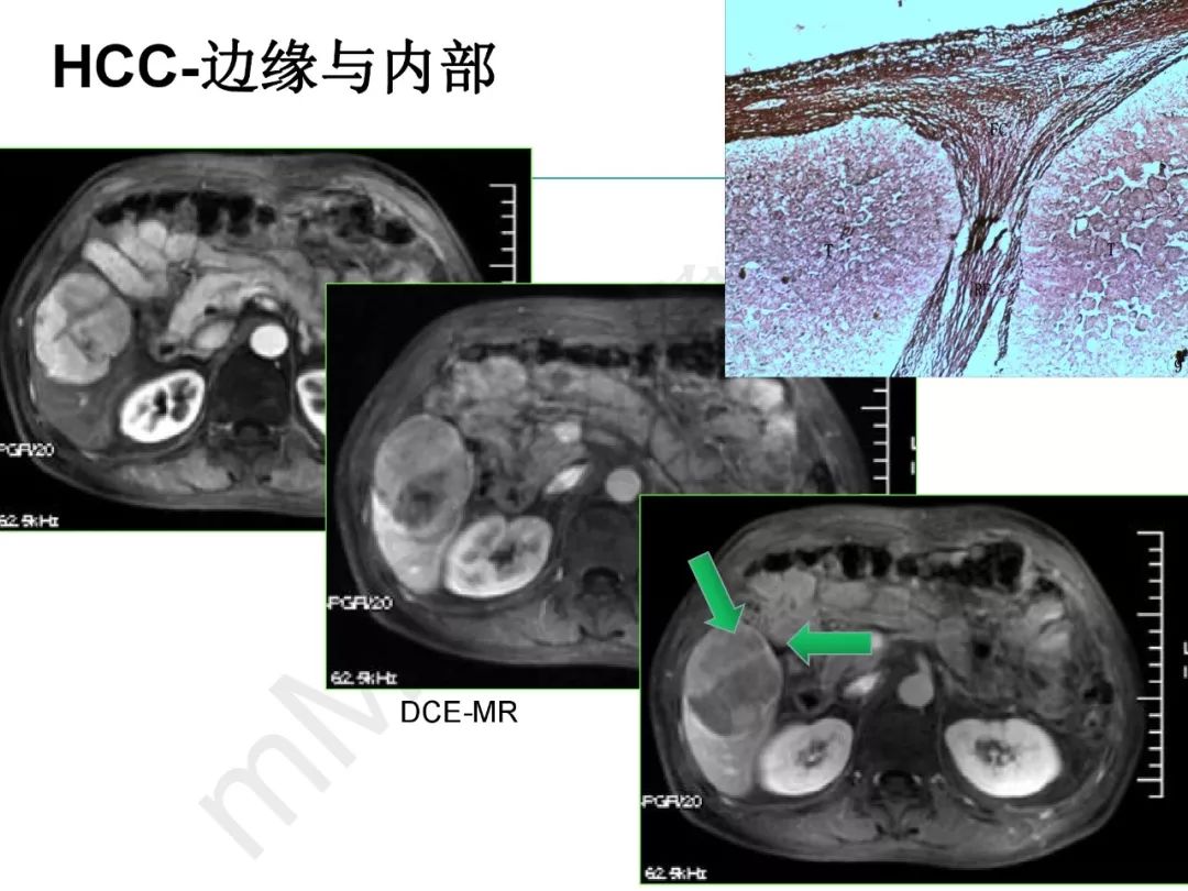 【PPT】纤维组织在肝脏炎性病变MR诊断中的价值