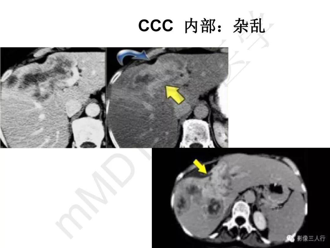 【PPT】纤维组织在肝脏炎性病变MR诊断中的价值