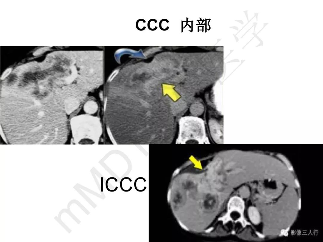 【PPT】纤维组织在肝脏炎性病变MR诊断中的价值