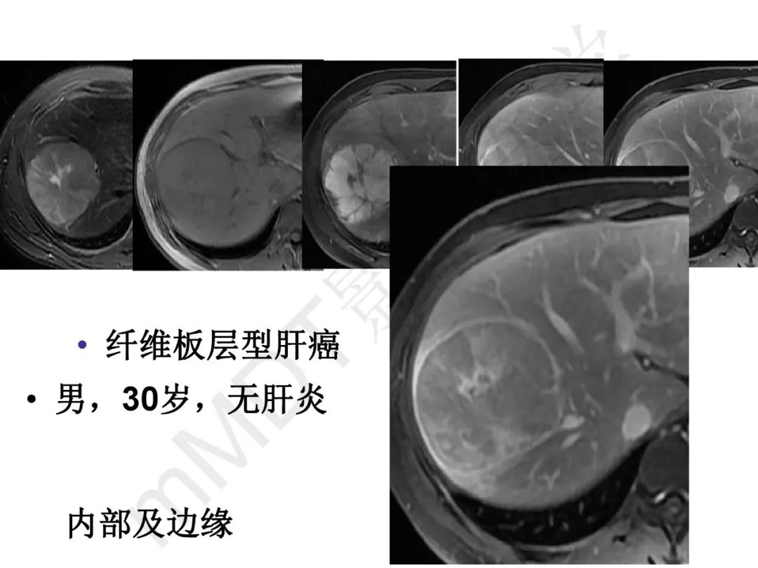 【PPT】纤维组织在肝脏炎性病变MR诊断中的价值