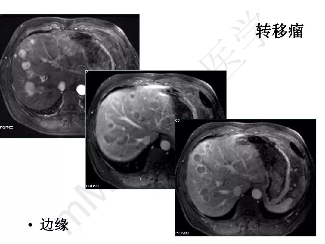 【PPT】纤维组织在肝脏炎性病变MR诊断中的价值