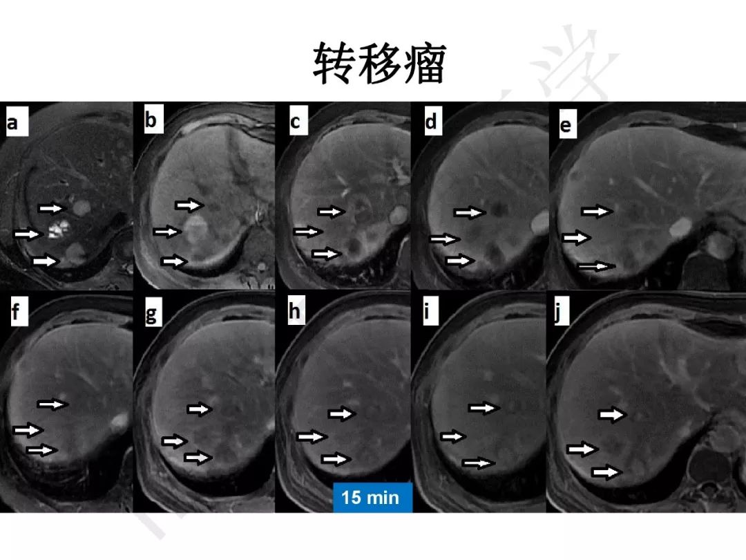 【PPT】纤维组织在肝脏炎性病变MR诊断中的价值