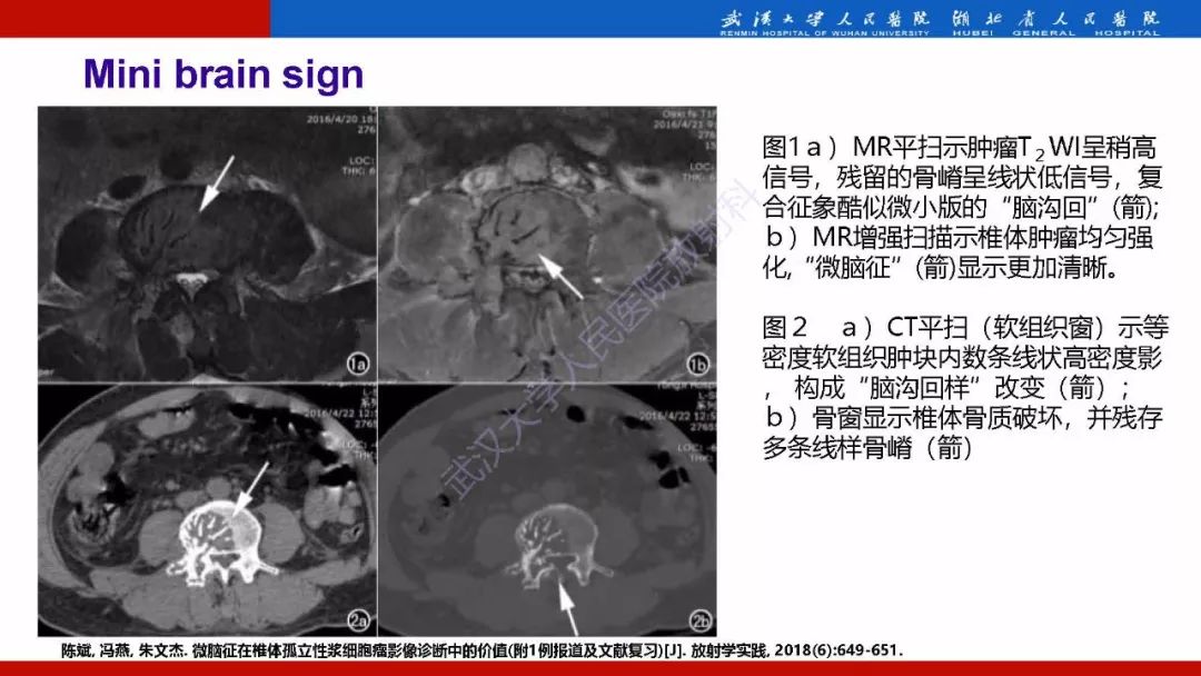 【PPT】脊柱孤立性浆细胞瘤影像诊断