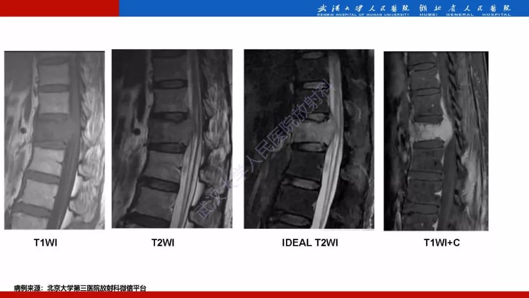 【PPT】脊柱孤立性浆细胞瘤影像诊断