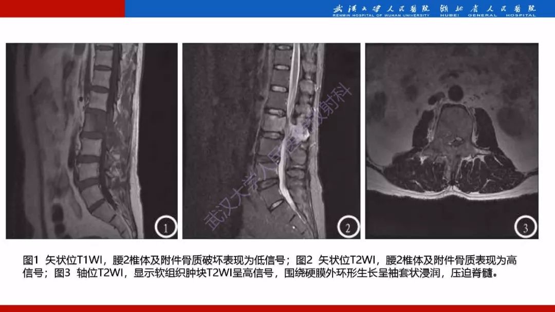 【PPT】脊柱孤立性浆细胞瘤影像诊断