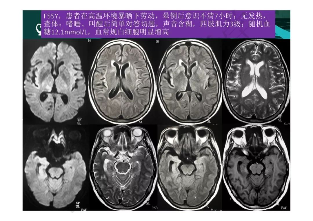 【PPT】临影结合看图识病之边缘脑区非肿瘤性病变
