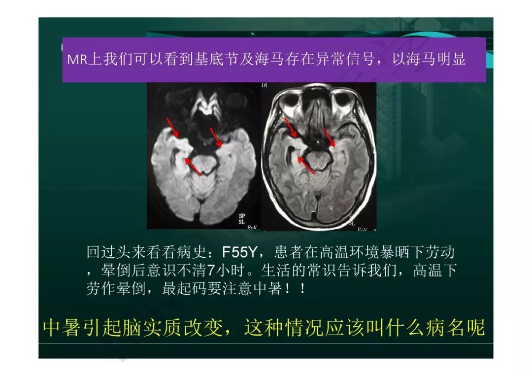 【PPT】临影结合看图识病之边缘脑区非肿瘤性病变