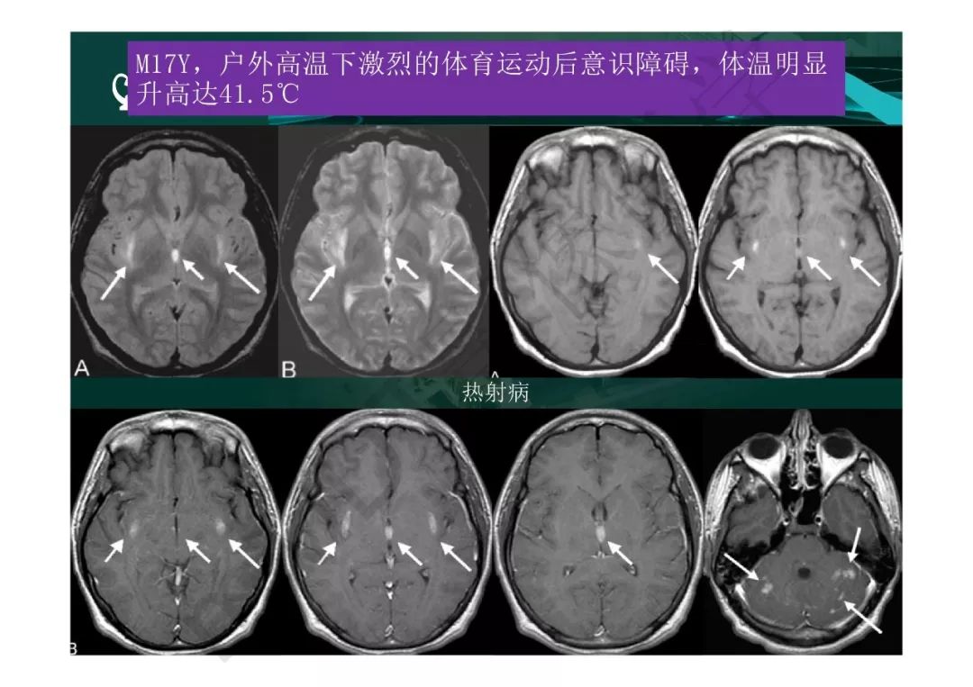 【PPT】临影结合看图识病之边缘脑区非肿瘤性病变
