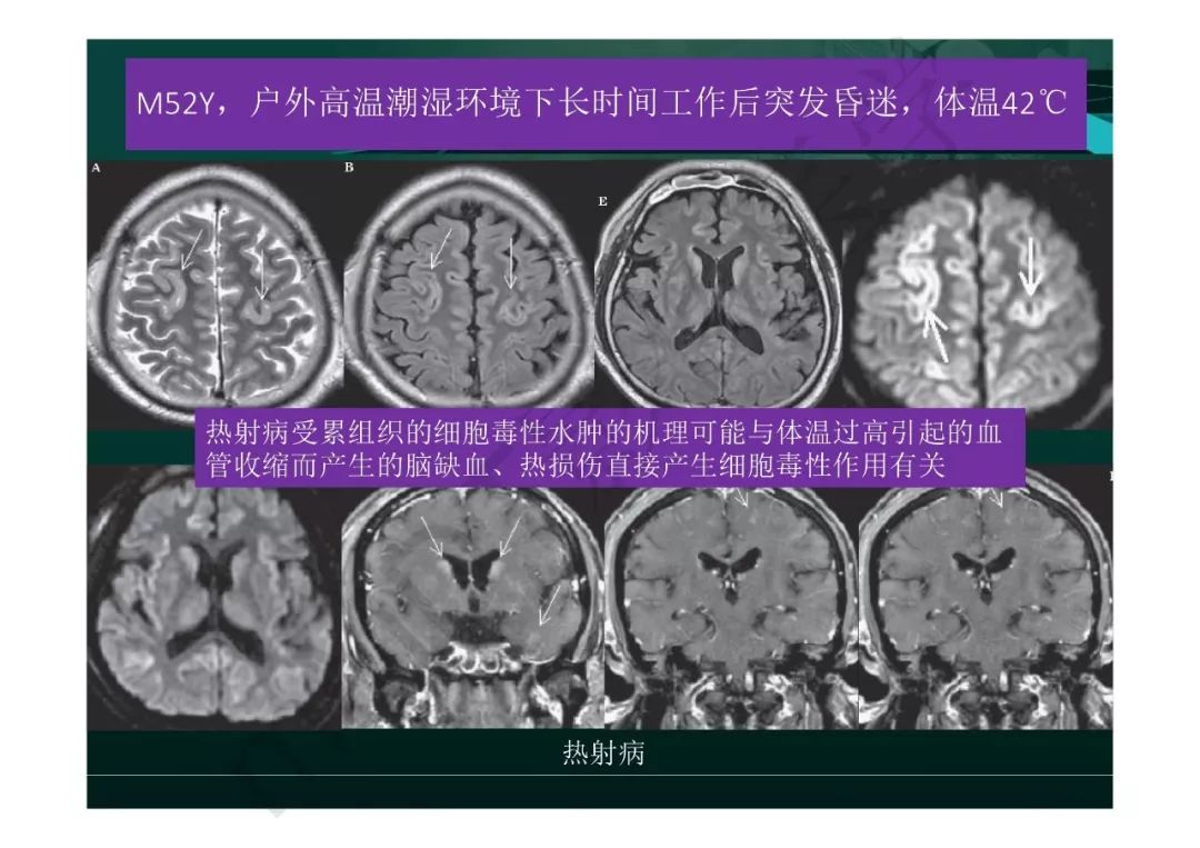 【PPT】临影结合看图识病之边缘脑区非肿瘤性病变