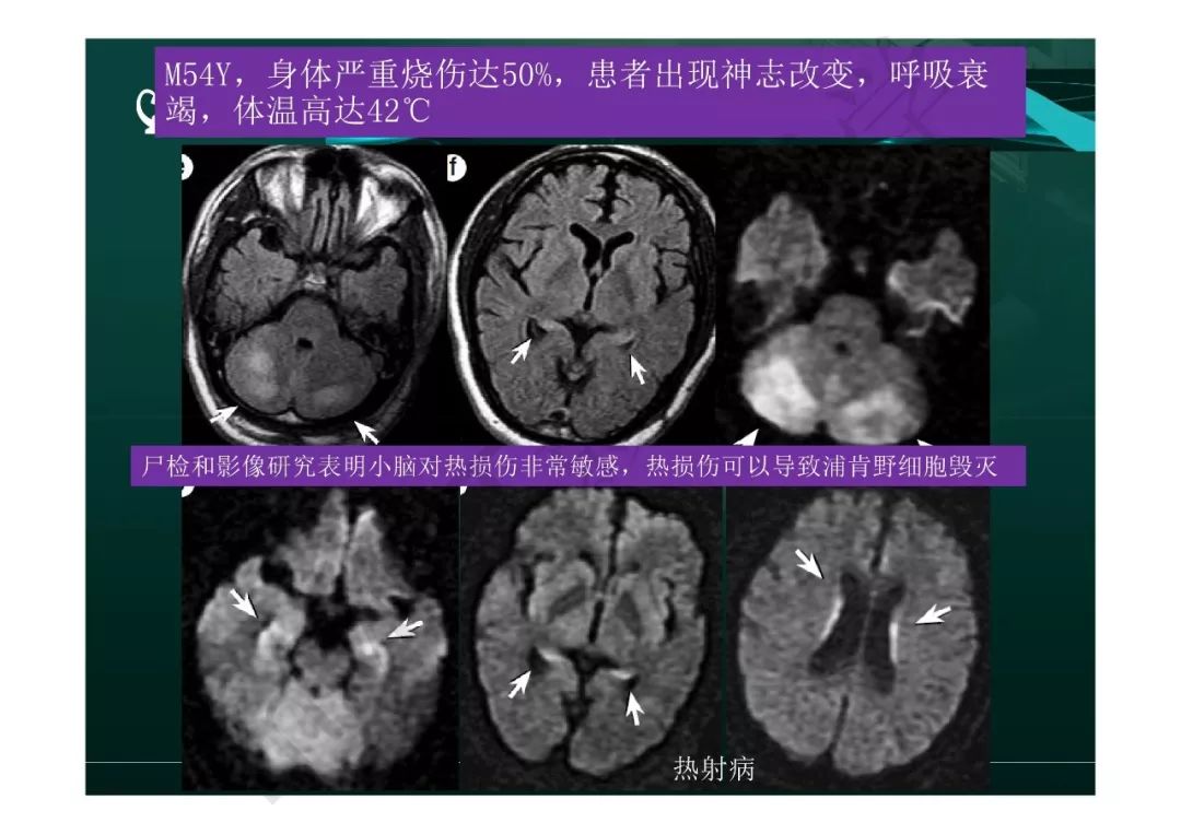 【PPT】临影结合看图识病之边缘脑区非肿瘤性病变