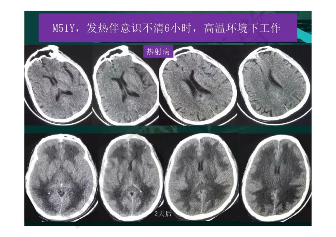 【PPT】临影结合看图识病之边缘脑区非肿瘤性病变