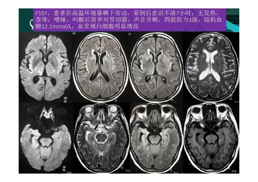 【PPT】临影结合看图识病之边缘脑区非肿瘤性病变