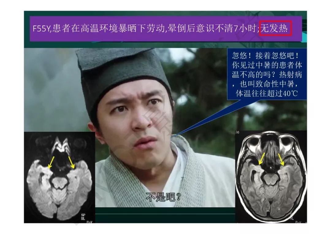 【PPT】临影结合看图识病之边缘脑区非肿瘤性病变