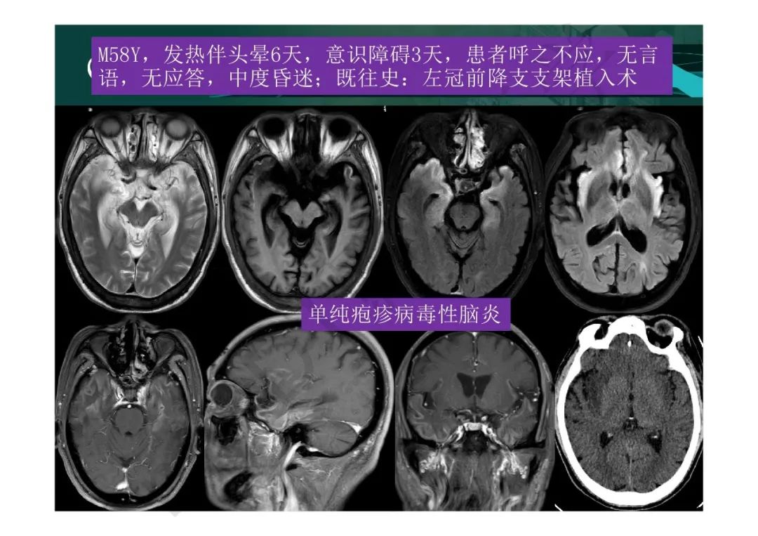 【PPT】临影结合看图识病之边缘脑区非肿瘤性病变