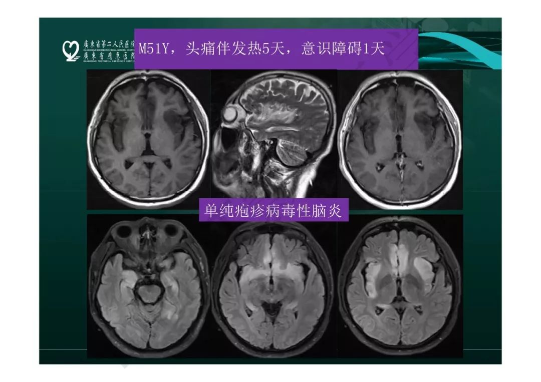 【PPT】临影结合看图识病之边缘脑区非肿瘤性病变