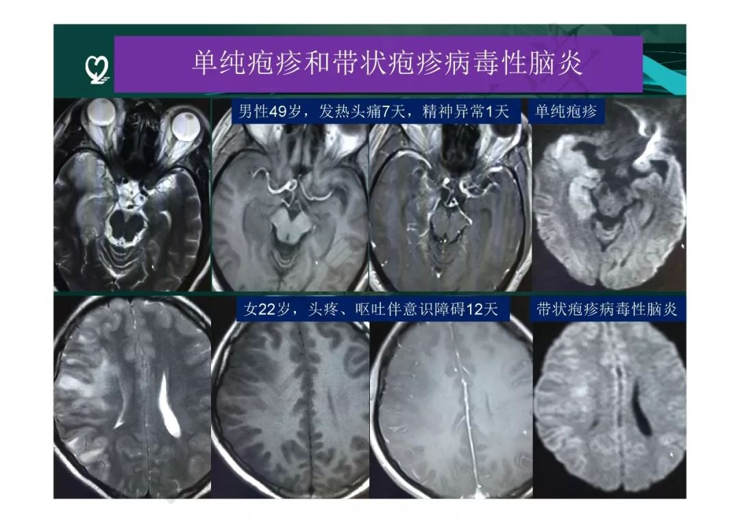 【PPT】临影结合看图识病之边缘脑区非肿瘤性病变