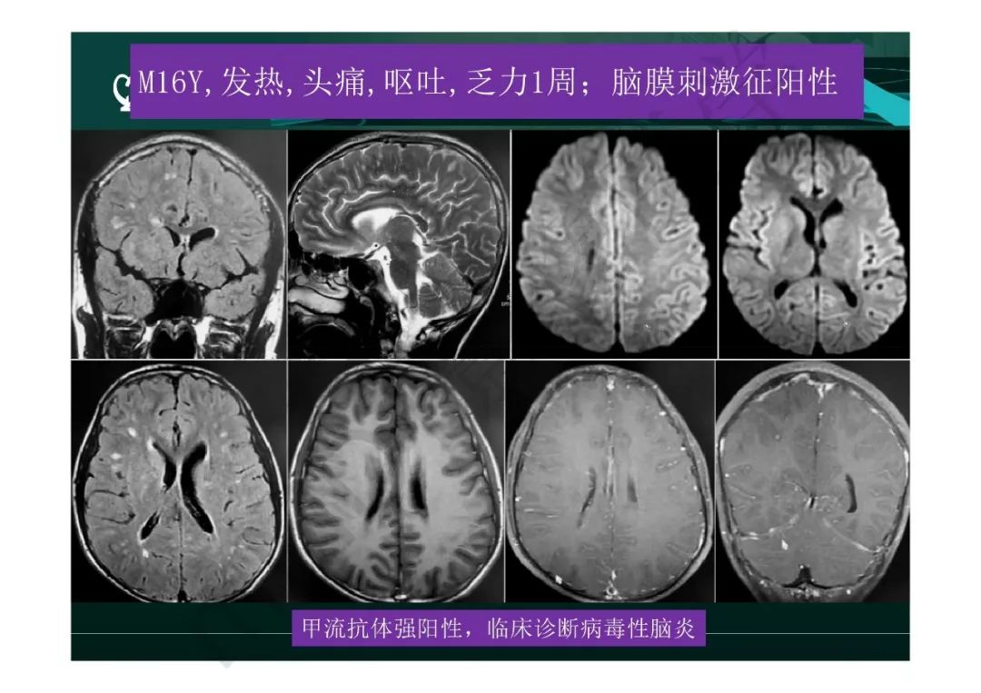 【PPT】临影结合看图识病之边缘脑区非肿瘤性病变