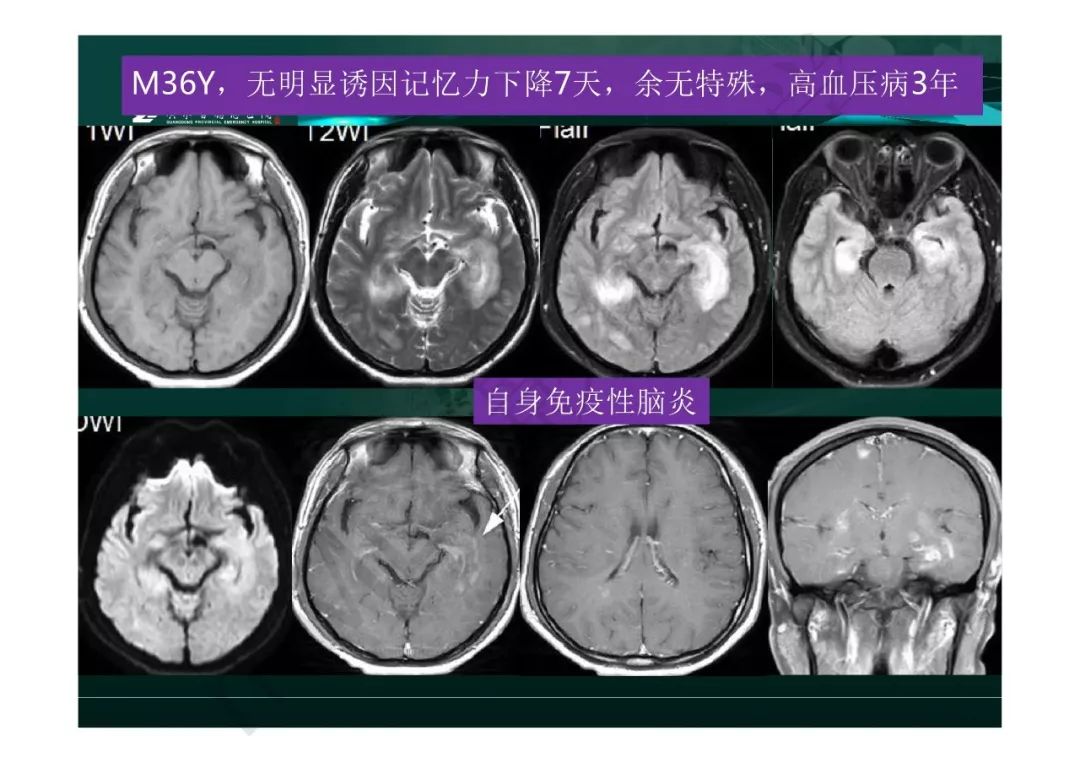 【PPT】临影结合看图识病之边缘脑区非肿瘤性病变