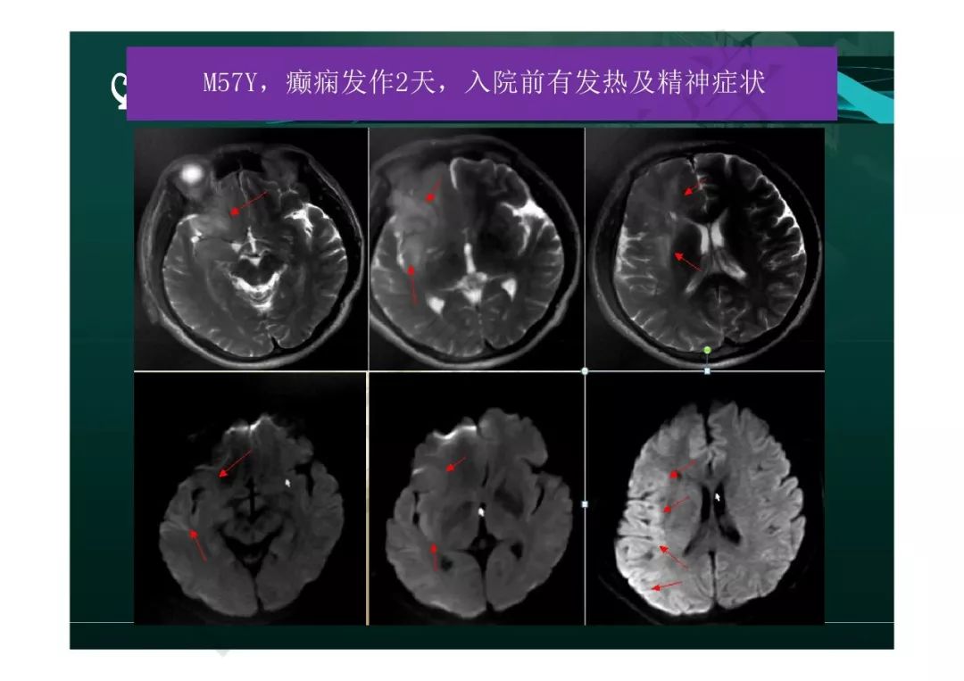 【PPT】临影结合看图识病之边缘脑区非肿瘤性病变