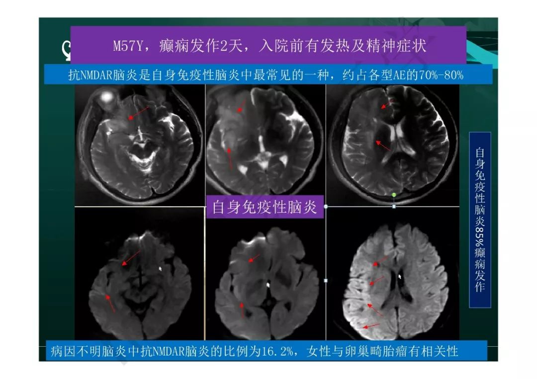 【PPT】临影结合看图识病之边缘脑区非肿瘤性病变