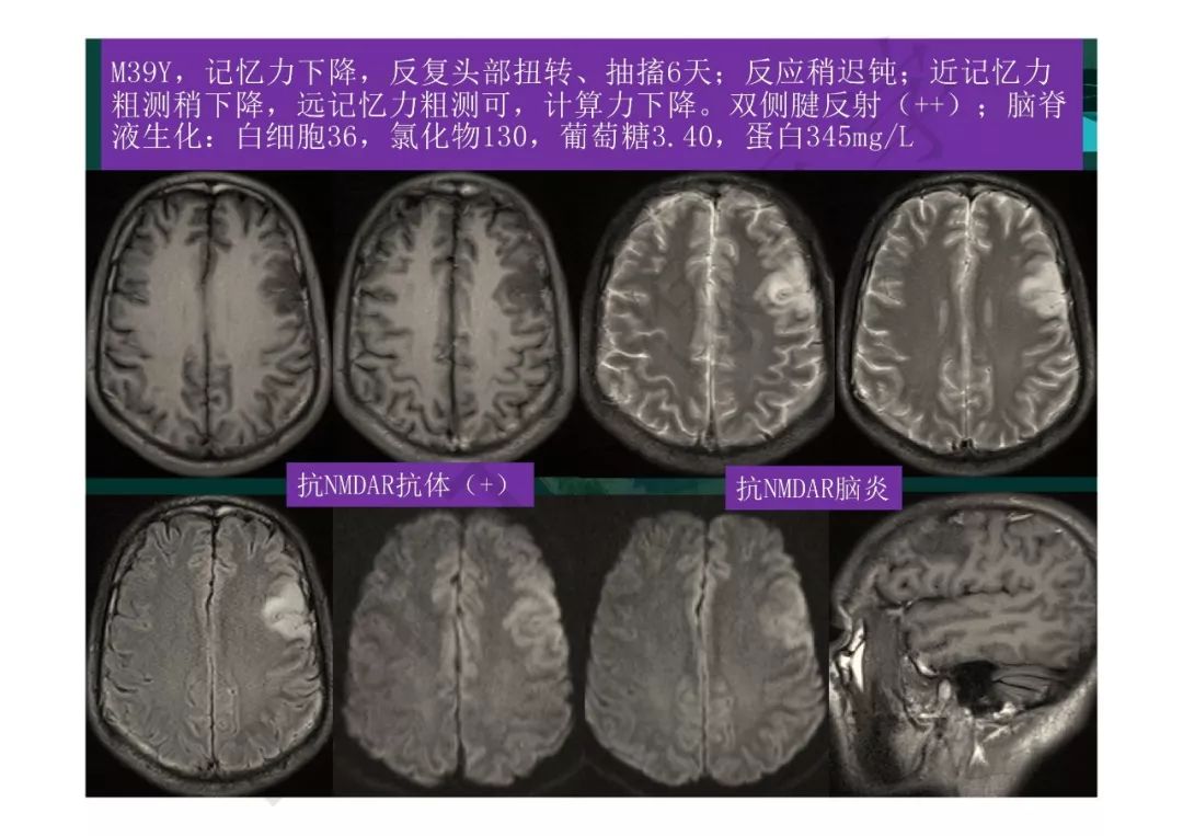 【PPT】临影结合看图识病之边缘脑区非肿瘤性病变