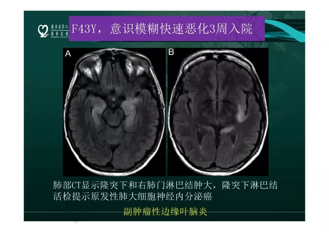 【PPT】临影结合看图识病之边缘脑区非肿瘤性病变