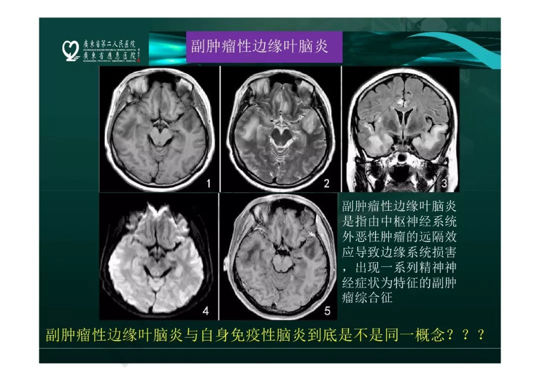 【PPT】临影结合看图识病之边缘脑区非肿瘤性病变