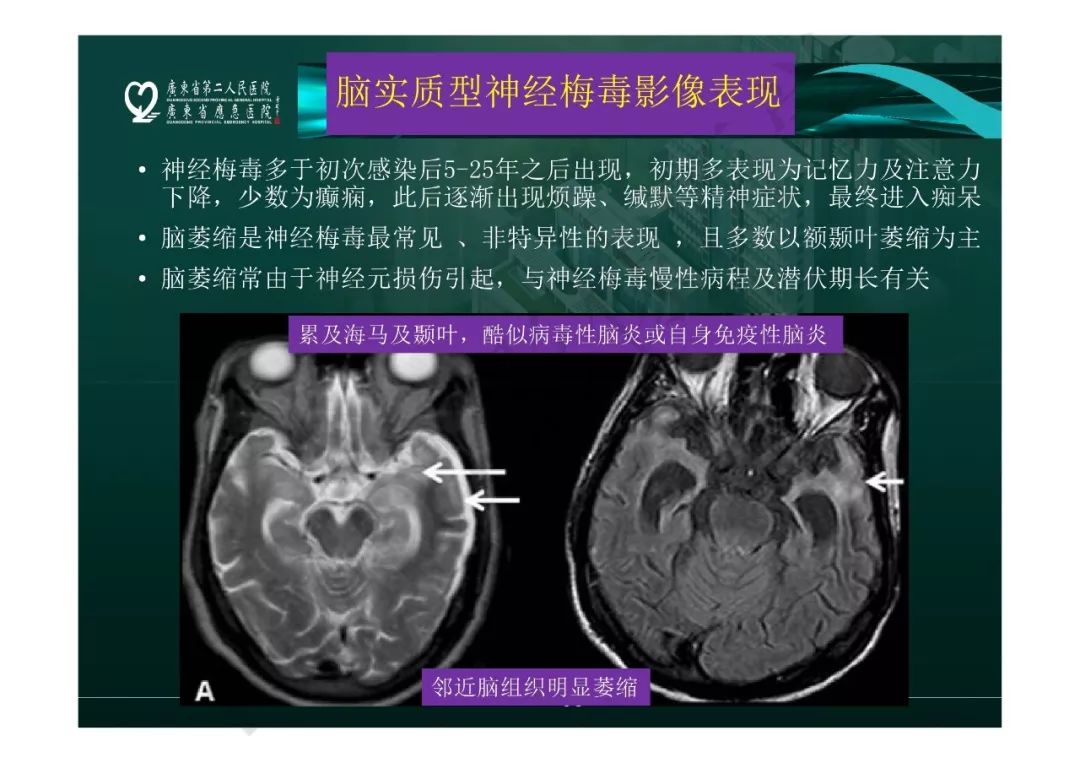 【PPT】临影结合看图识病之边缘脑区非肿瘤性病变