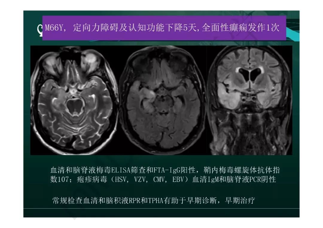 【PPT】临影结合看图识病之边缘脑区非肿瘤性病变