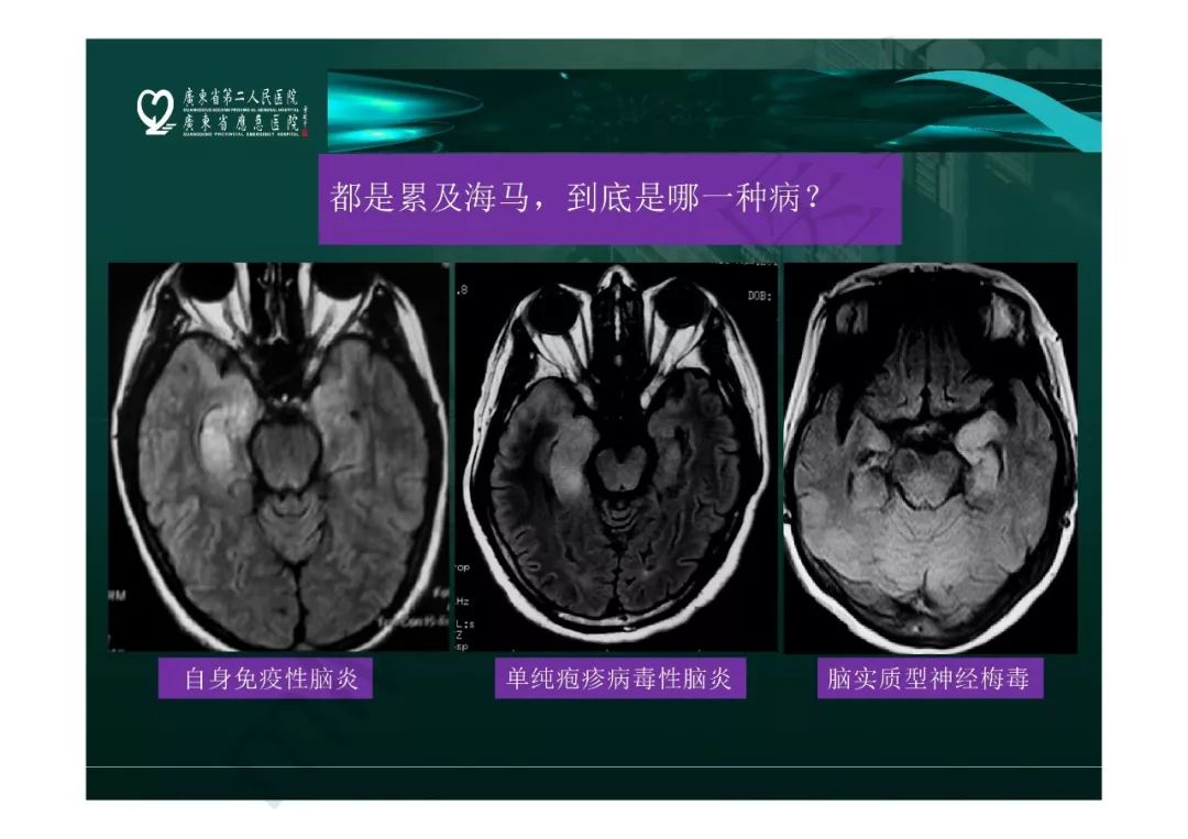 【PPT】临影结合看图识病之边缘脑区非肿瘤性病变