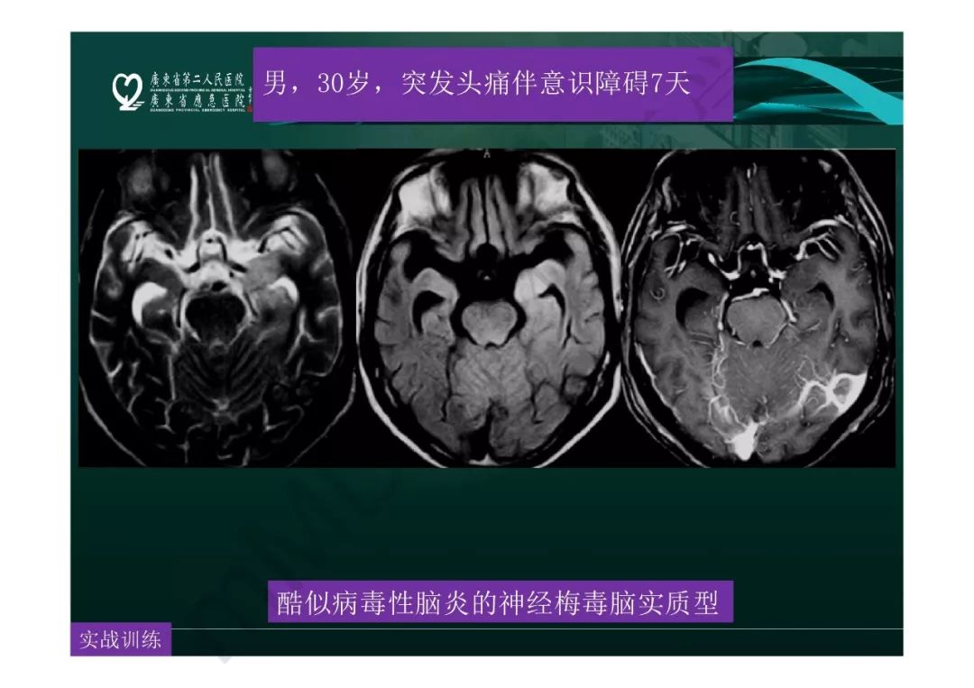 【PPT】临影结合看图识病之边缘脑区非肿瘤性病变