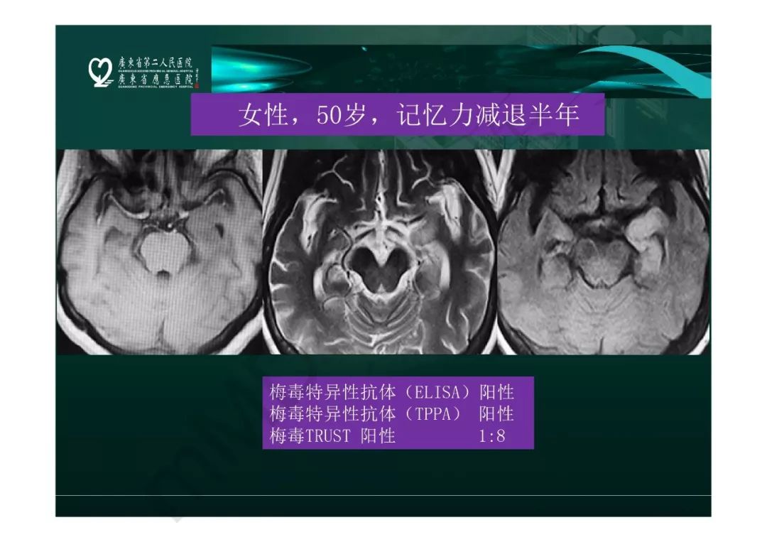 【PPT】临影结合看图识病之边缘脑区非肿瘤性病变
