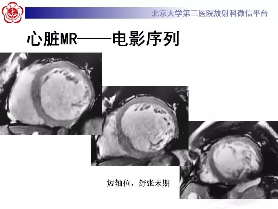 【病例】心肌致密化不全1例MR