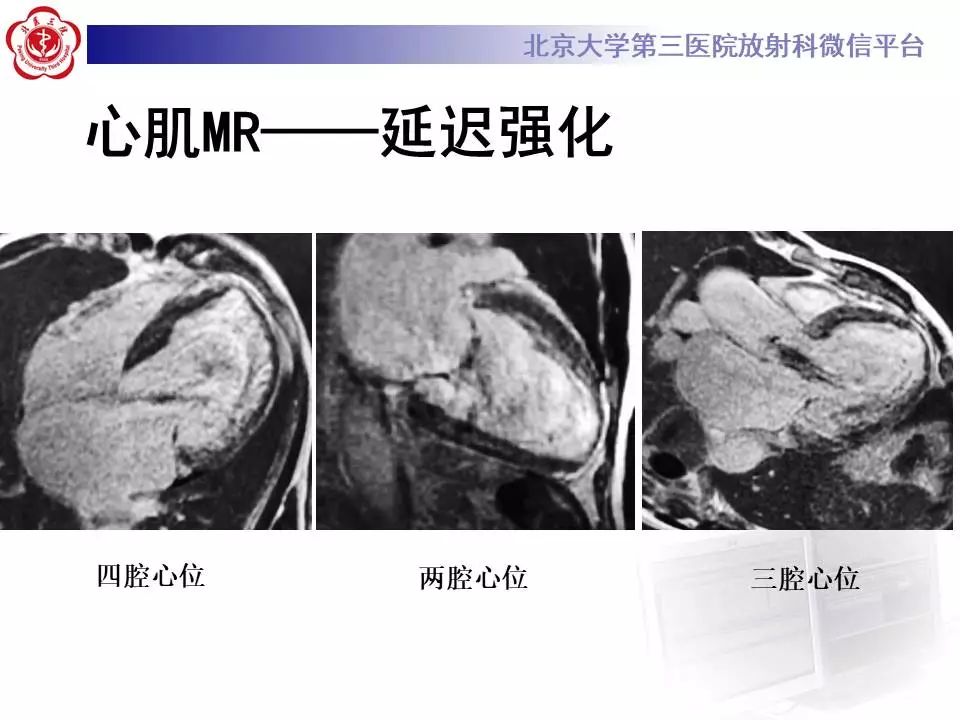 【病例】心肌致密化不全1例MR