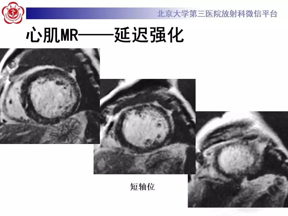 【病例】心肌致密化不全1例MR