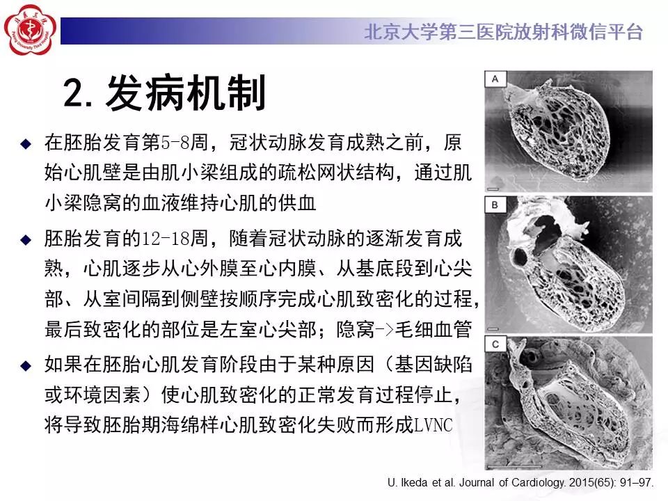 【病例】心肌致密化不全1例MR