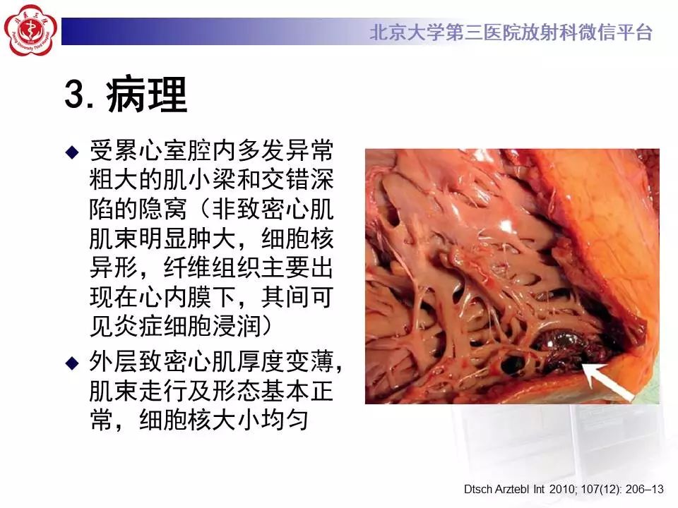 【病例】心肌致密化不全1例MR