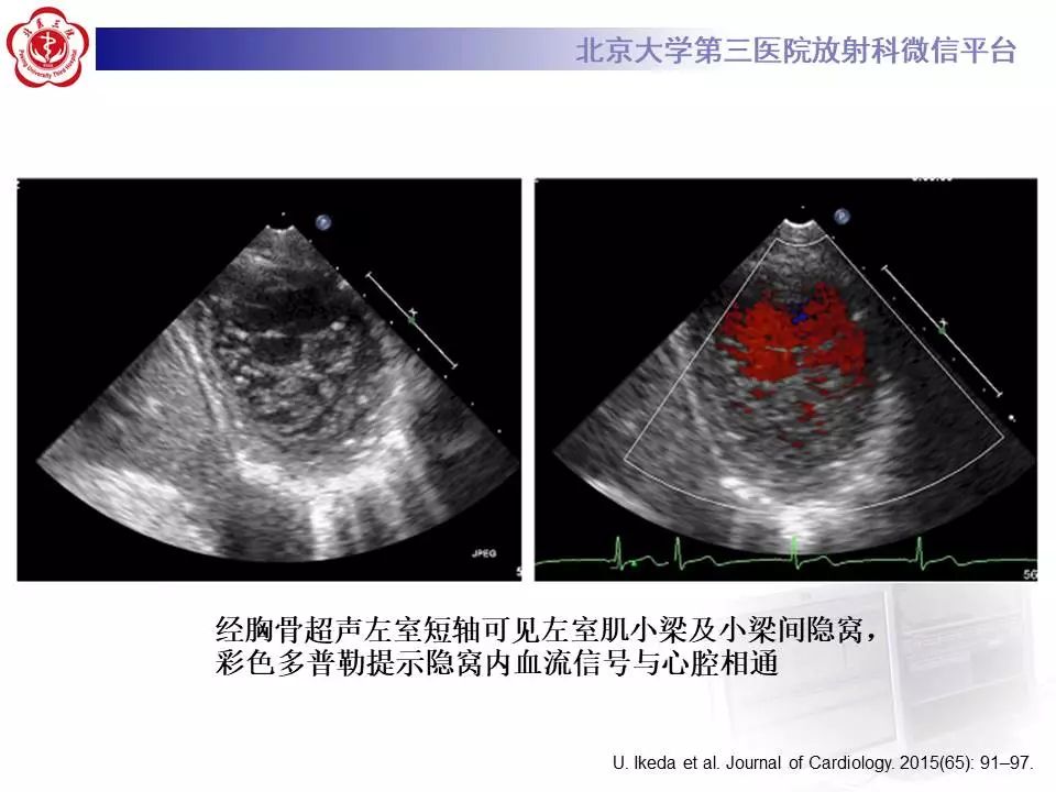【病例】心肌致密化不全1例MR
